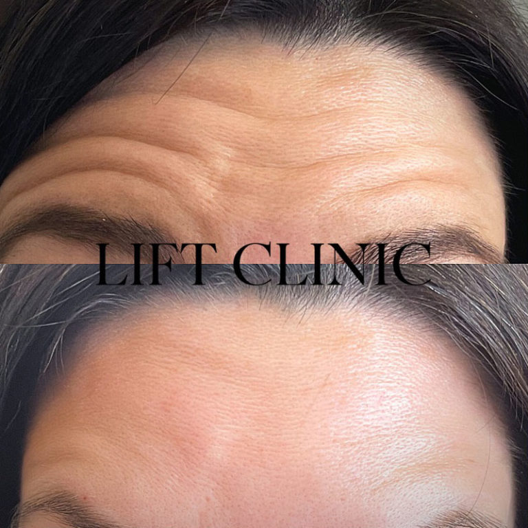 Botox and Lip Fillers Before and After Result by Lift Clinic Toronto