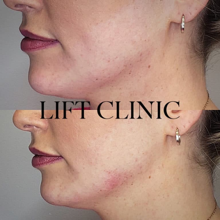 Botox and Dermal Fillers Before and After Result by Lift Clinic Toronto