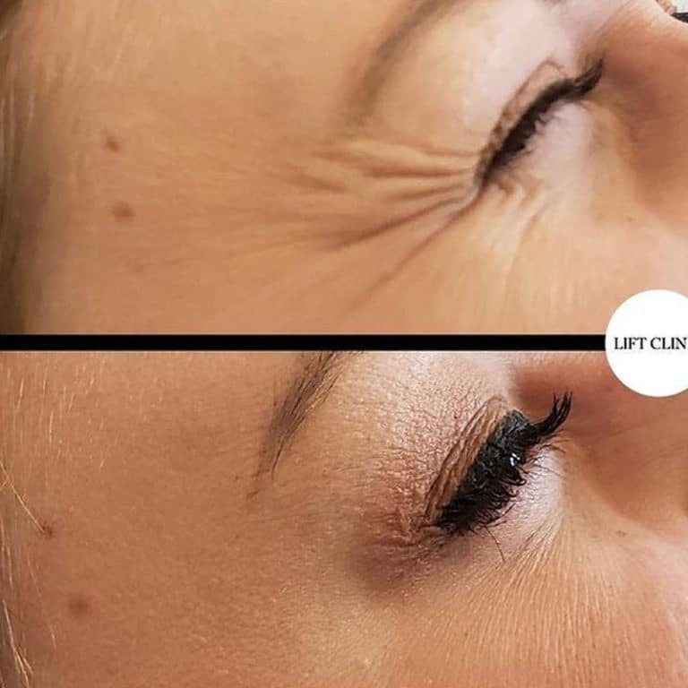 Botox in Toronto before and after photo