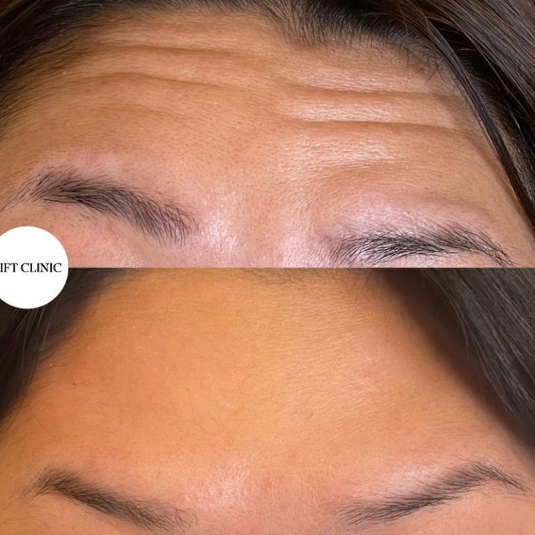 Botox in Toronto before and after photo