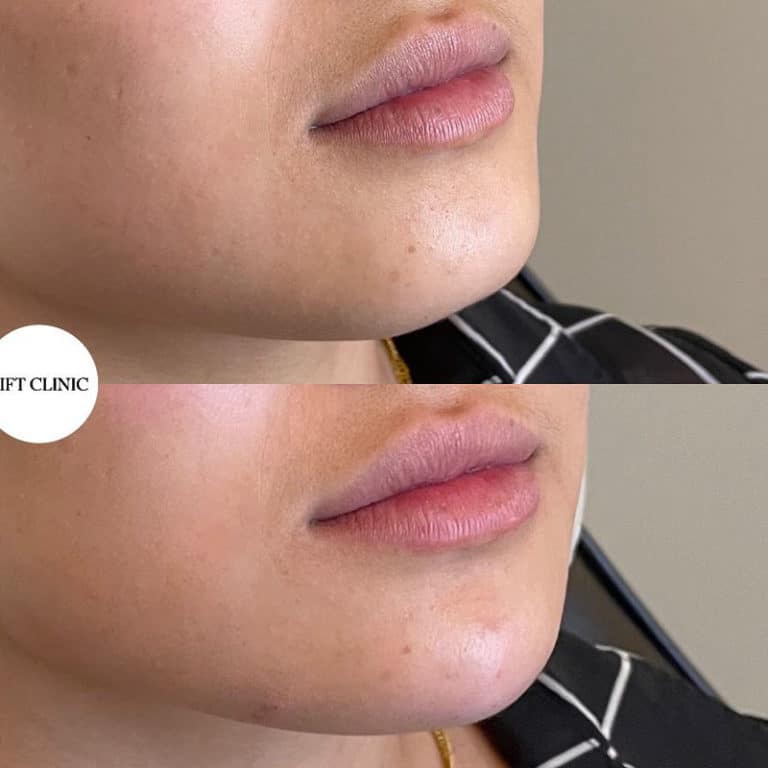 Botox and Lip Fillers Before and After Result by Lift Clinic Toronto
