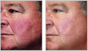 IPL BBL Laser Treatment Photofacial Before and After