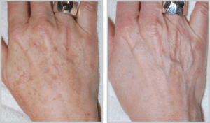 IPL BBL Laser Treatment Photofacial Before and After