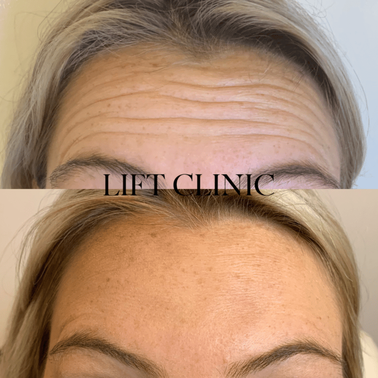 Botox before and after photo - 11's, also known as frown lines, treated for a smooth forehead. 26 units of Botox & Dysport was used to relax the muscles in this area.