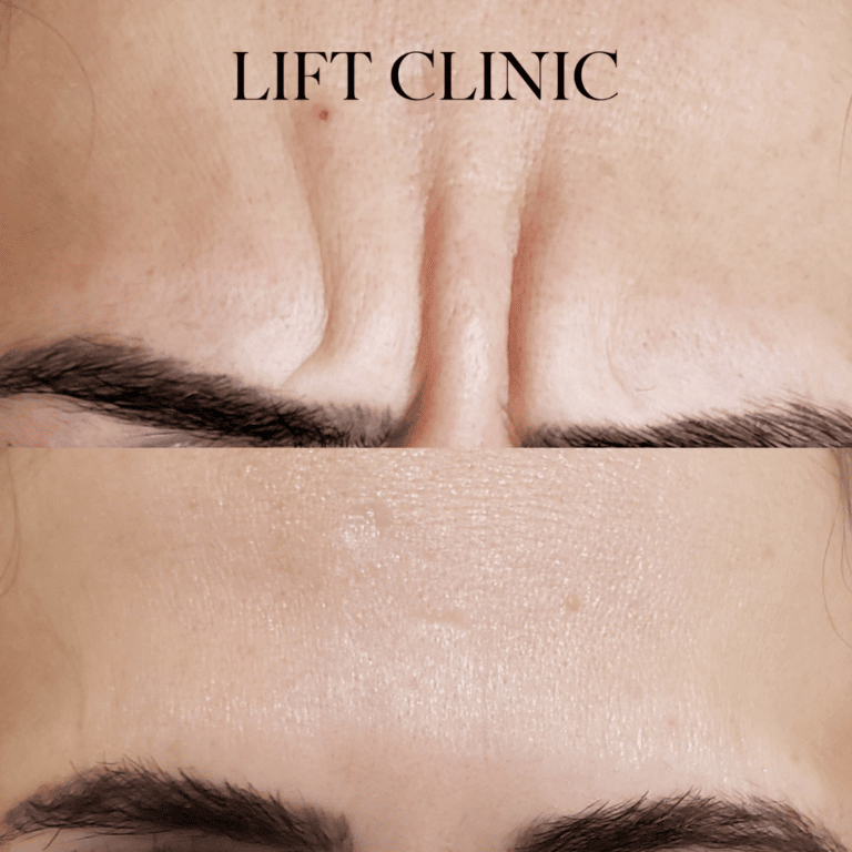 Botox before and after photo - Botox & Dysport anti-wrinkle injections for frown lines, also known as 11's.