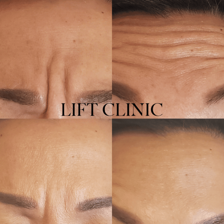 Botox before and after photo - First time Botox & Dysport treatment, we stayed conservative and topped up with additional units of Dysport at the two-week follow-up. We recommend a 2-week follow-up appointment for first time clients.
