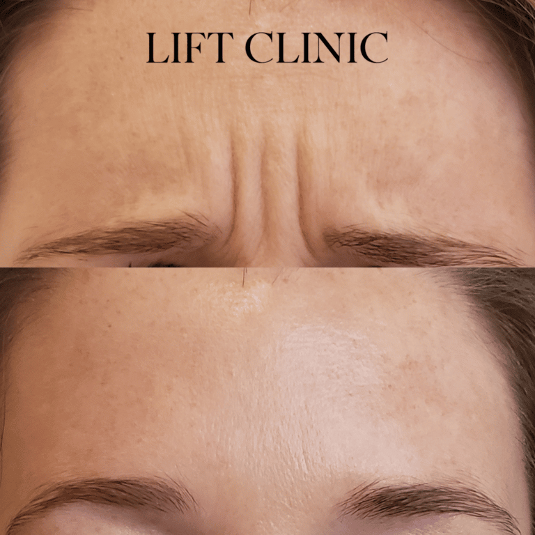Botox before and after photo - Botox & Dysport for frown lines. Soft and smooth.