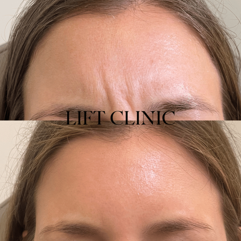 Botox before and after photo - Botox & Dysport for the 11's. We used 19 units of wrinkle-reducing cosmetic injectables.