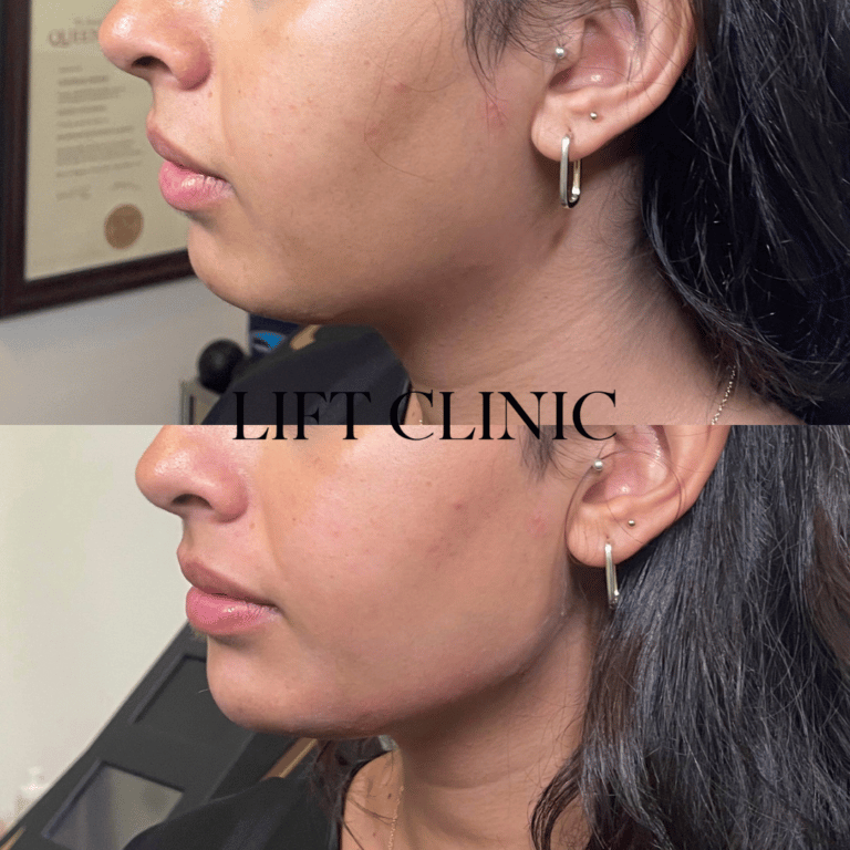 Dermal fillers before and after photo - This clients misaligned mandible led to asymmetry in the lower face (see previous photo). We used three syringes of dermal fillers to enhance her jawline and add chin projection which drastically improved her profile.