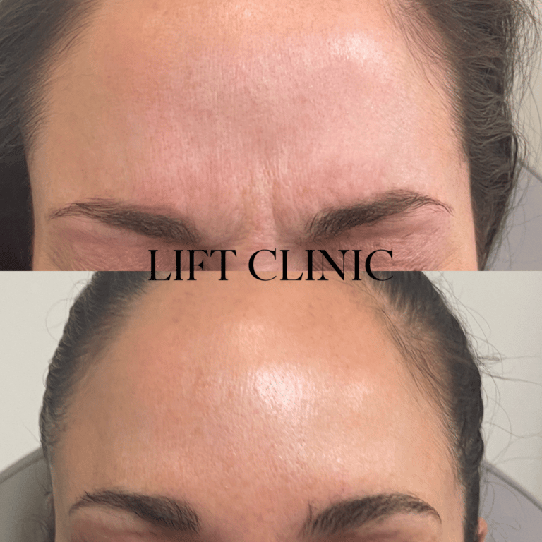 Botox before and after photo - Botox & Dysport softened frown lines using 19 units. Treating this area opens up the eyes and raises the eyebrows.