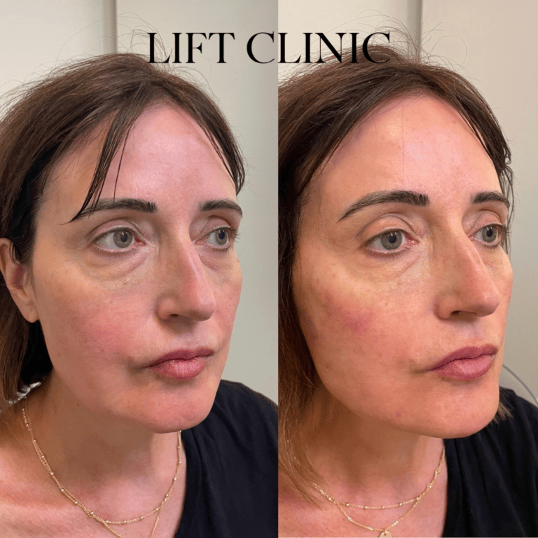 Dermal fillers before and after photo - This client wanted an overall rejuvenation. We used three syringes of hyaluronic acid dermal fillers spread in various areas, including cheeks, jawline, chin and marionette lines for a subtle rejuvenation.