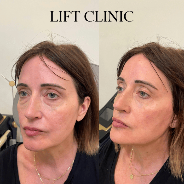 Dermal fillers before and after photo - This client wanted an overall rejuvenation. We used three syringes of hyaluronic acid dermal fillers spread in various areas, including cheeks, jawline, chin and marionette lines for a subtle rejuvenation.