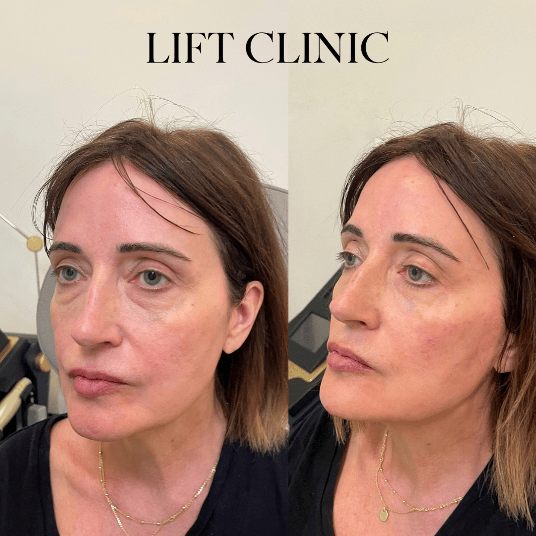 Before and After Cheek Filler at Align Injectable Aesthetics