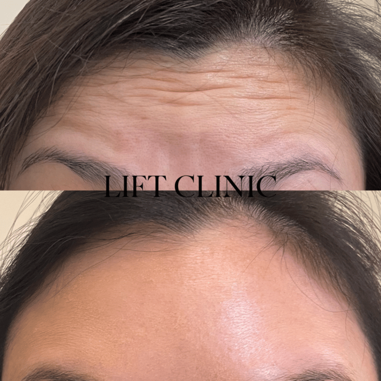 Botox before and after photo - Baby botox using 5 units of Botox & Dysport for this patient's forehead. Movement remained but the lines were gone.