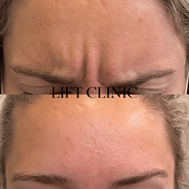 Botox before and after photo - Frown lines treated with 30 units of anti-wrinkle injections to soften the 11's and raise the brows.