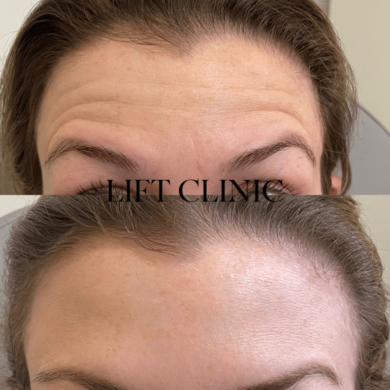 Botox before and after photo - Forehead wrinkles treated with wrinkle-reducing injectables Botox & Dysport. Treatment was in conjunction with treating the frown lines.