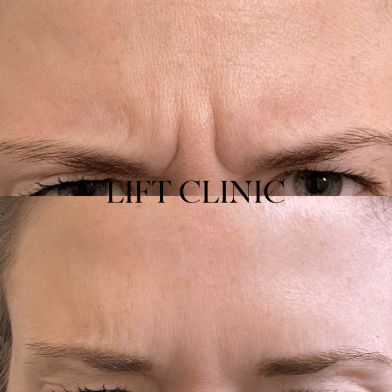 Botox before and after photo - Baby Botox (Dysport) for frown lines. She wanted to reduce the lines while still having movement.