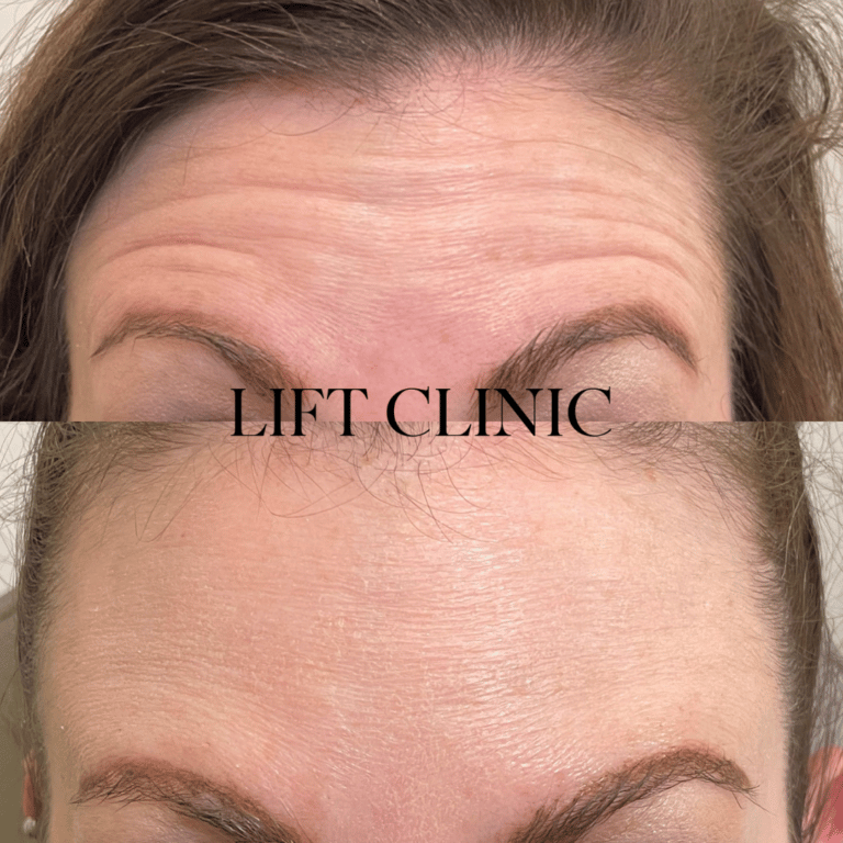 Botox before and after photo - Softening the forehead muscles so they become less active with Botox & Dysport.