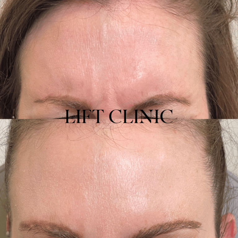 Botox before and after photo - Botox & Dysport for frown lines.