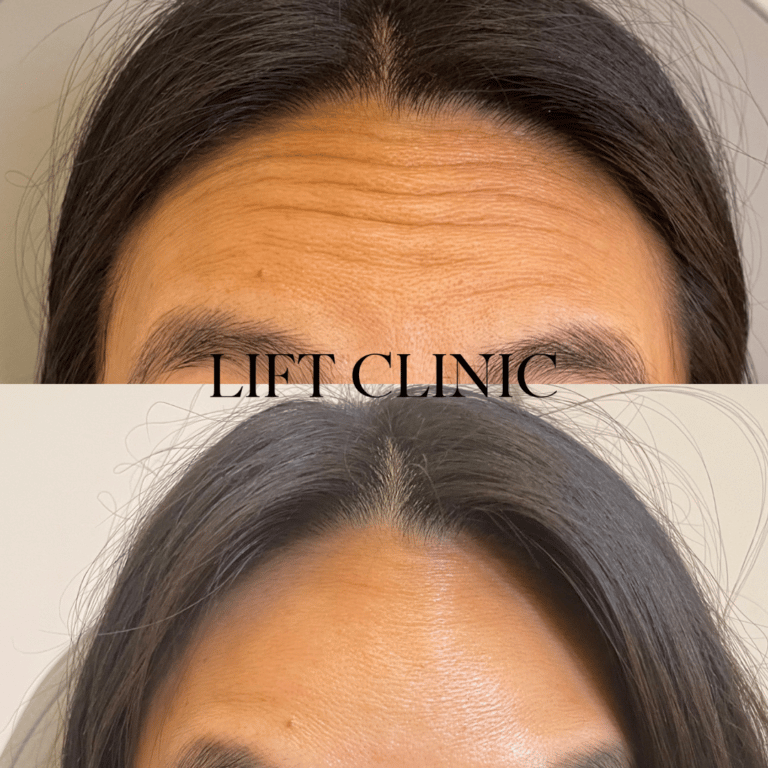 Botox before and after photo - Forehead lines treated with 7 units of Botox & Dysport.
