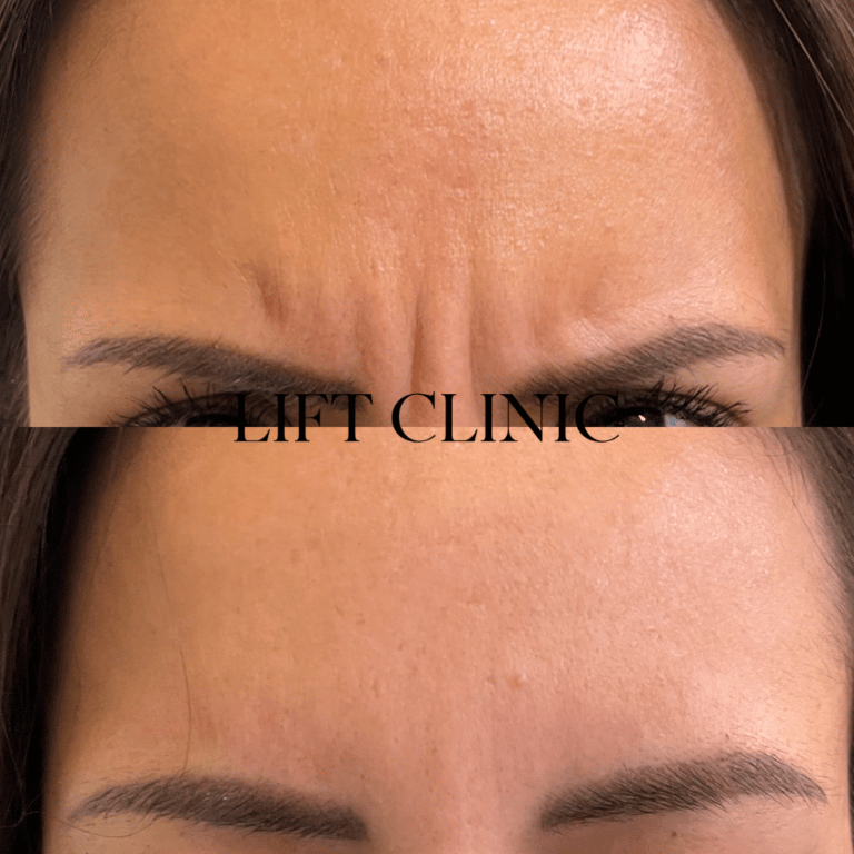 Botox before and after photo - Frown lines treated with Botox & Dysport. This client needs a series of treatments to remove the static line (wrinkle at rest).