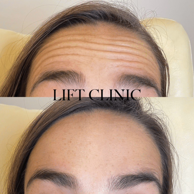 Botox before and after photo - Satisfying softening of the forehead lines, with subtle elevation to the brows.