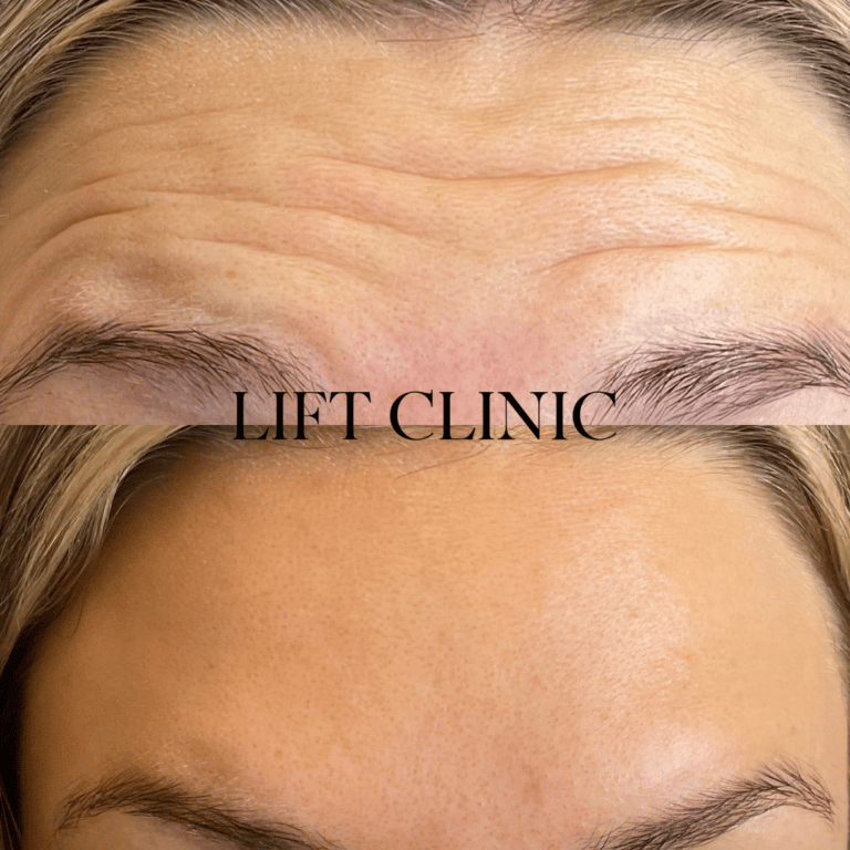 Botox before and after photo - Relaxing the forehead muscle to reduce wrinkles using 7-10 units of Botox & Dysport. Frown lines were treat as well to keep the eyebrows in place.