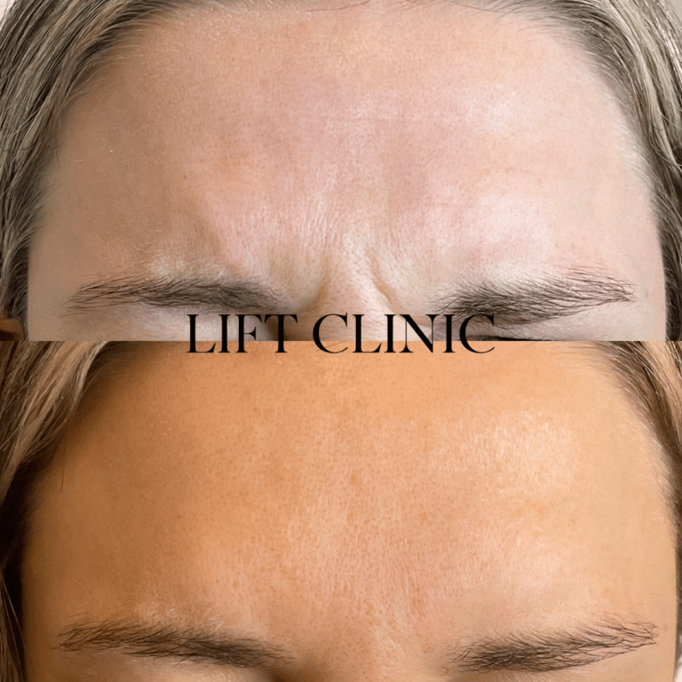 Botox before and after photo - Frown line injections to reduce muscle strength in the 11's using Botox & Dysport anti-wrinkle injections.