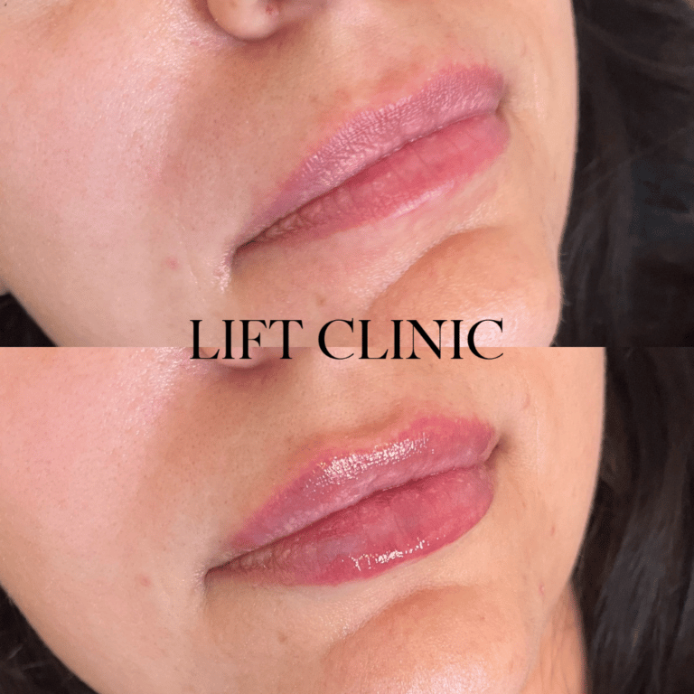 This client wanted to enhance her natural lip volume. A mini lip plump of hyaluronic acid lip filler was used for this subtle enhancement.