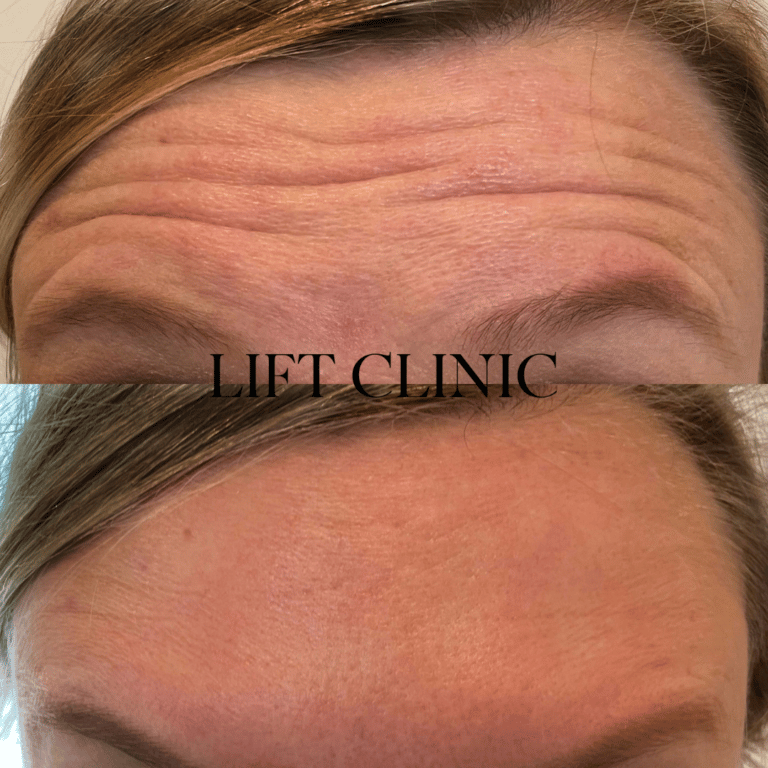 Botox before and after photo - Botox & Dysport for forehead lines. This client wanted an overall rejuvenation and skin glow.