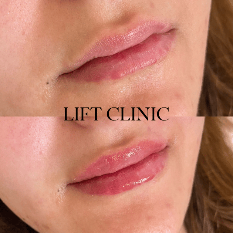 This client wanted to correct asymmetry. A mini lip plump of hyaluronic acid lip filler was used for this subtle enhancement.