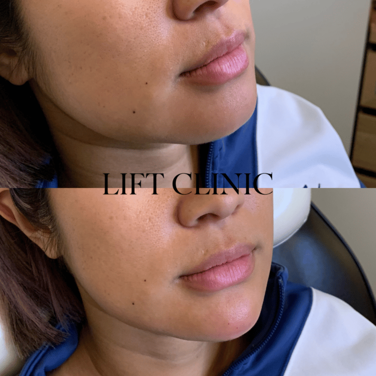 Dermal fillers before and after photo - This client wanted a more youthful face shape. We started with jawline slimming with a masseter reduction using Botox/Dysport, followed by chin filler to elongate the chin and add subtle projection for an enhanced, youthful v-line profile.