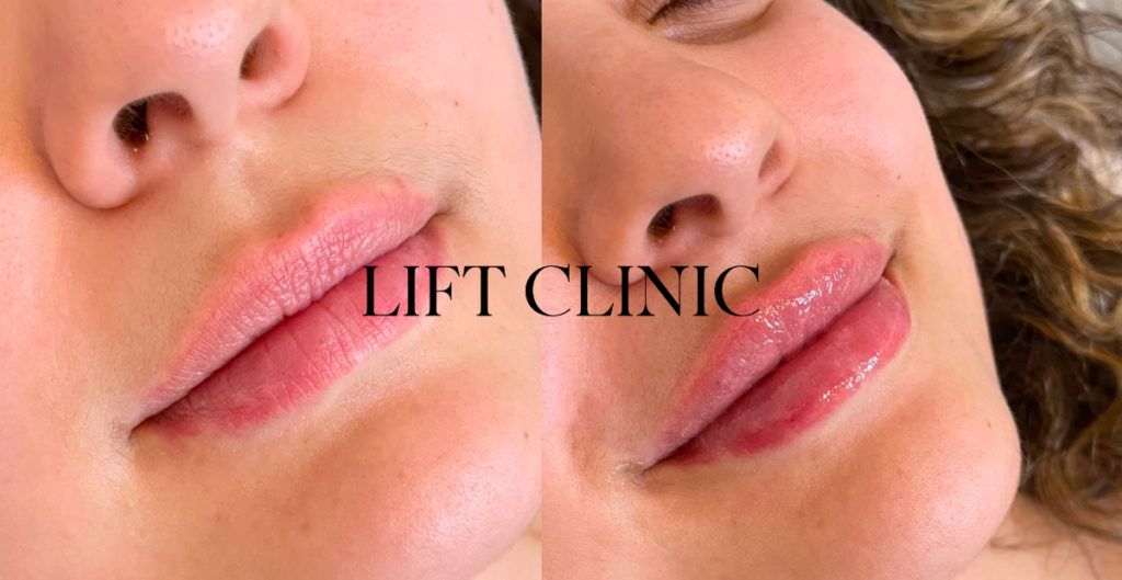 How long do lip fillers last?