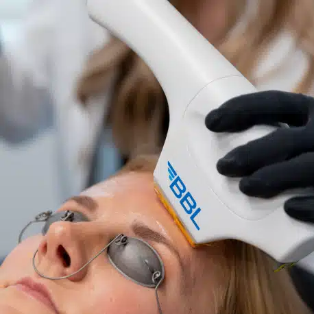 Enhancing Skin Rejuvenation with Moxi Laser and BBL (BroadBand Light) Treatments - Rectangle 317 2