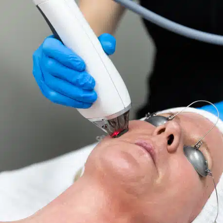 Introducing Moxi Laser - The Future of Skin Rejuvenation - Rectangle 317 3