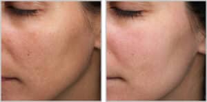 Moxi Laser Treatment in Toronto Before & After -3-Treatments-at-Level-2