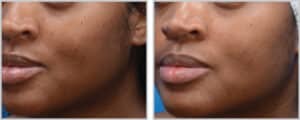 Moxi Laser Treatment in Toronto Before & After Level-1--5-mJ,-5%-Density