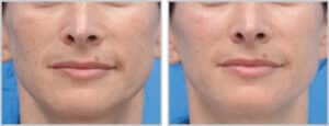Moxi Laser Treatment in Toronto Before & After - Level-2--7.5-mJ,-15%-Density